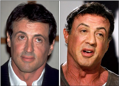 sylvester-stallone-plastic-surgery-procedure.png